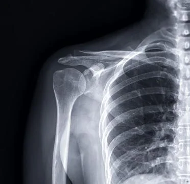 X-ray Shoulder joint shoulder front view for diagnosis fracture of shoulder.. Stock Illustration
