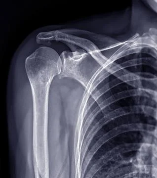 X-ray Shoulder joint shoulder front view for diagnosis fracture of shoulder.. Stock Illustration