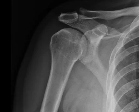 X-ray shoulder radiograph show state of injury Stock Photos