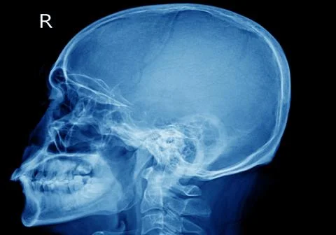 X-ray skull Finding The cranial vault is intact.No abnormal intra-cranial cal Stock Photos