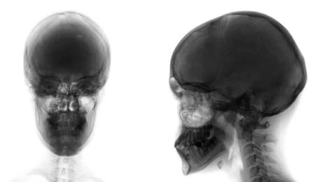 X-ray of the skull. Osteoid-osteoma of the frontal sinus. Negative. Stock Photos