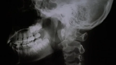 X-ray off skull,side Stock Footage