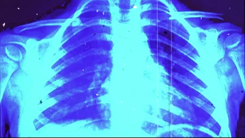 X-ray Slides Of Human Lungs Organs Overlay Stock Footage 292932395