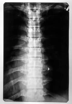 X-ray of the spinal card Stock Photos