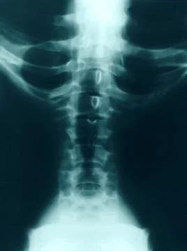 X-ray of the spine Stock Photos
