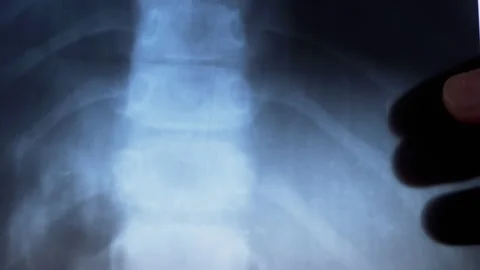 X-ray of Spine, Ribs, Bones of a Small Child. Curvature of spine. Kyphosis. 4K Video stock 149602674