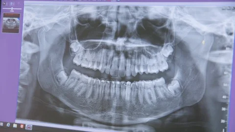 X-ray of teeth being shown on monitor in dental clinic Stock Footage