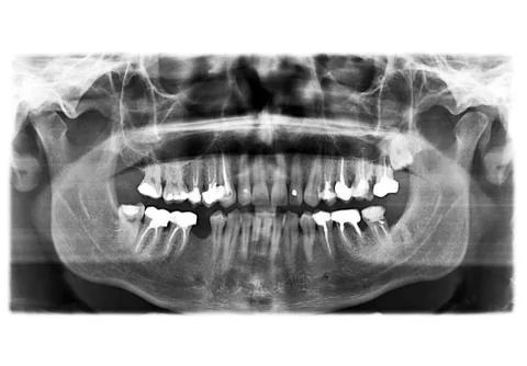 X ray of teeth 스톡 사진