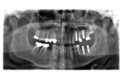 X ray of teeth Stock Photos