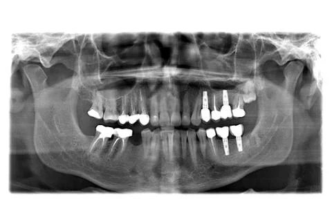 X ray of teeth Stock Photos