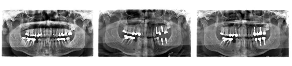X ray of teeth Stock Photos