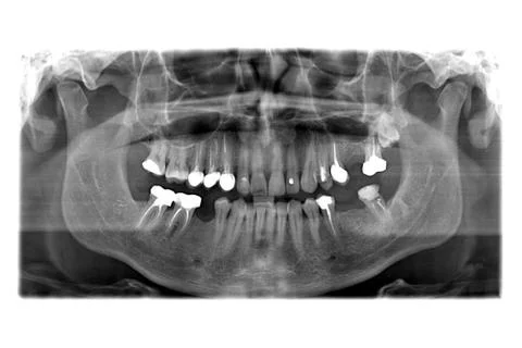 X ray of teeth Stock Photos