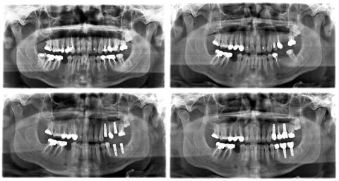 X ray of teeth Foto stock