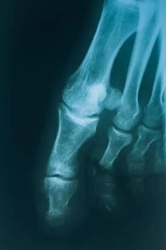 X-ray of the toes. Leg injury, real x-ray with foot Stock Photos