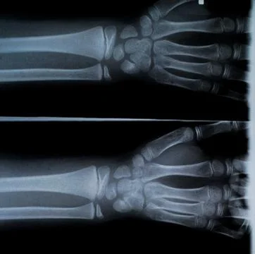 X Ray of two hands and forearm Stock Photos