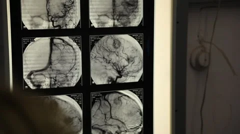 X-ray of the veins Stock Footage 6694213