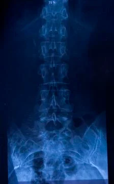 X ray of Vertebrae - Spinal column. Stock Photos