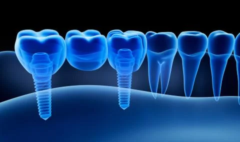 X-ray view of denture with implant.  Xray view. Medically accurate 3D illus.. Stock Illustration