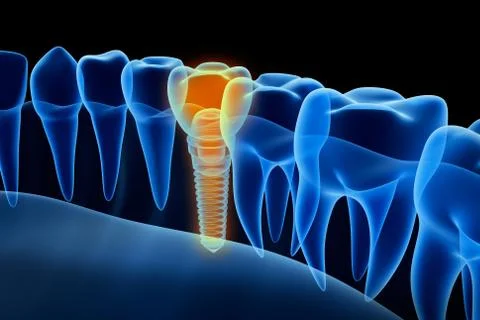 X-ray view of denture with implant.  Xray view. Medically accurate 3D illus.. Stock Illustration