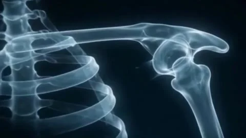 An X-ray view of a human shoulder, collarbone, and ribcage. Stock Footage 340318556
