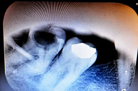 X ray on wisdom 8th lower right tooth with a teeth decay, after exposed ner.. Stock Photos