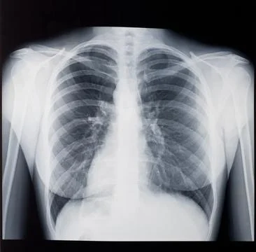 X-ray of the woman's lungs, front view. Stock Photos