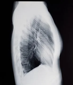 X-ray of the woman's lungs, side view. Stock Photos