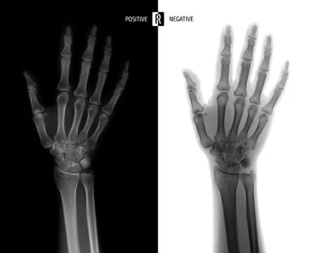 X-ray of the wrist joint. Normal. Negative. Stock Photos