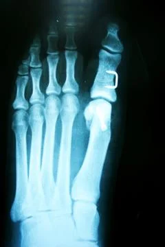 X ray , x-ray image photo of feet front view with a clove after fracture. Stock Photos