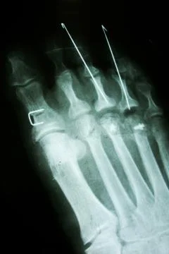 X ray , x-ray image photo of feet front view with a clove after fracture. Stock Photos