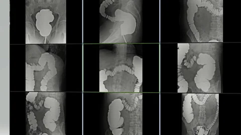 X-rays of bowel examination with barium Vídeo Stock 111647498