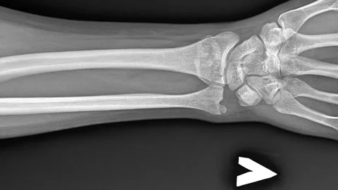 X-rays of a broken arm. Human Anatomy, image of a bone injury with displacement Vídeos de archivo 135040658