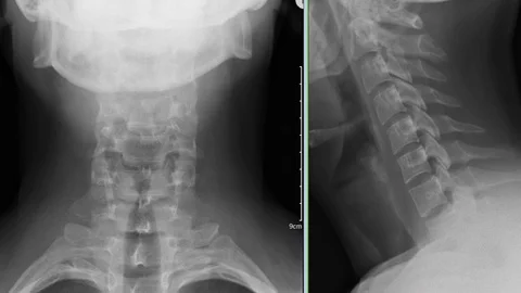 X-rays of the cervical spine of the human spine Vídeo Stock 111647699