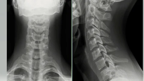 X-rays of cervical spine instability Vídeo Stock 111647679