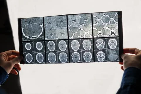 X-rays in the doctor's hand. X-rays of the human brain. Isolated on white Stock Photos