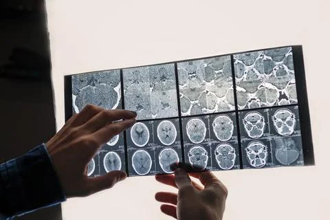 X-rays in the doctor's hand. X-rays of the human brain. Isolated on white Stock Photos