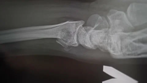 X-rays of a fractured radial bone with displacement. The doctor is studying the Stock Footage 134938467