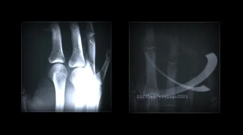 X-rays of the hands. Abstract medical elements. Alpha channel. Stock-Footage 43979889
