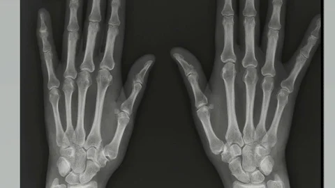 X-rays of the hands of both hands Vídeo Stock 111647506