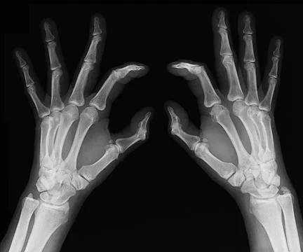 X-rays of hands Stock-Fotos