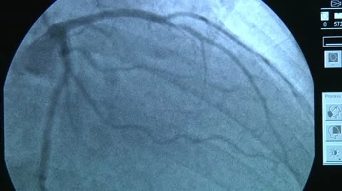 X-rays of the heart 1 Stock Footage 18179629
