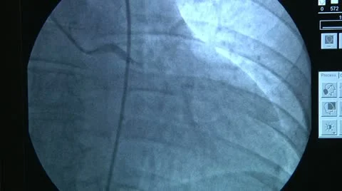 X-rays of the heart 2 Stock Footage 18179602