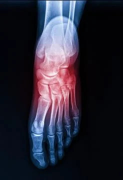 X-rays of the human foot, highlighted in red Stock Photos
