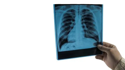 X-rays of human lungs on an isolated white background, picture of the lungs  Stock Photos