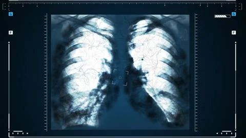 X-rays of the human lungs or physical therapy for doctors with lung problems Stock Footage 154678831