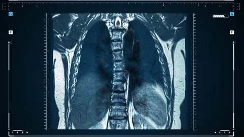 X-rays of the human lungs or physical therapy for doctors with lung problems Stock Footage 154678959