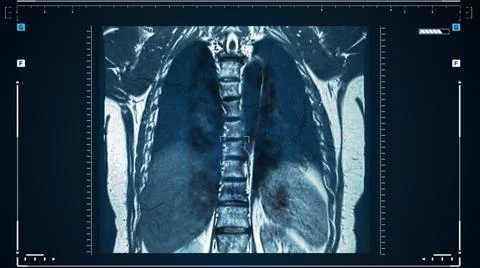 X-rays of the human lungs or physical therapy for doctors with lung problems Stock Illustration