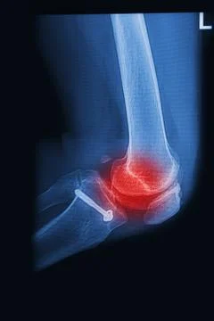 X rays image  broken knee joint with implant,image x-rays painful of knee joi Stock Photos