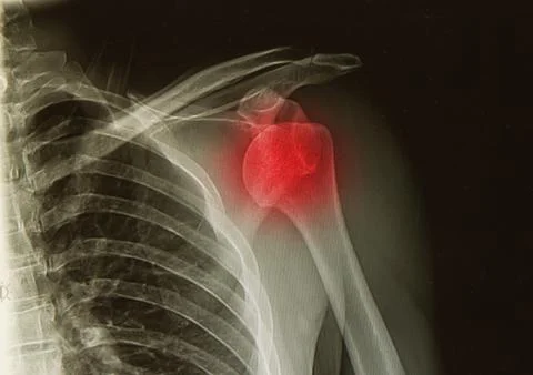 X-rays image of  the painful or injury shoulder joint ,shoulder dislocation Stock Photos