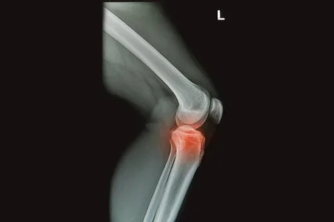 X-rays image of  the painful or injury knee joint, knee trauma Stock Photos